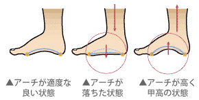 アーチの状態